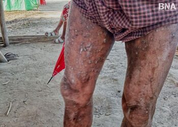 IDPs in Arakan Region Urgently Need Medical Aid