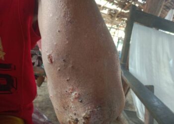 Over 200 Displaced Children in Ngapali Town Suffering from Skin Diseases