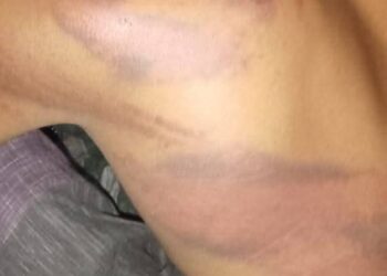 Rohingya Man Abducted and Tortured in Cox’s Bazar, Family Forced to Pay Ransom